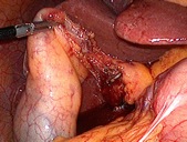 胆嚢管の切離